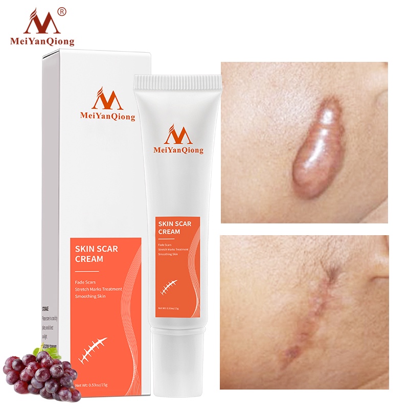 MeiYanQiong Acne Scar Removal Cream Skin Repair Stretch Marks giảm sẹo lồi, lõm, sẹo thâm, do mụn giúp phục hồi các tổn thương trên da thúc đẩy tái tạo da 15ml