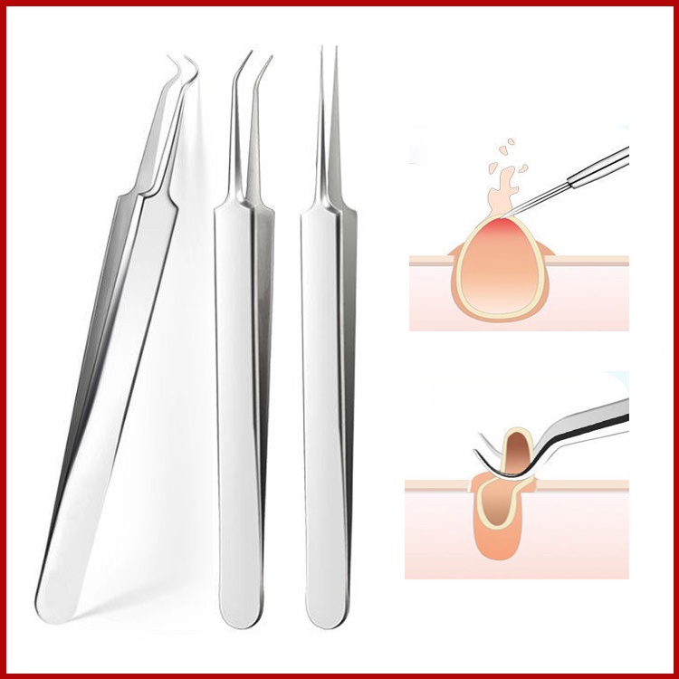 Cây nặn mụn, Nhíp gắp mụn bằng thép không gỉ cao cấp có hộp, nhíp gắp mụn tiện lợi, an toàn cho da