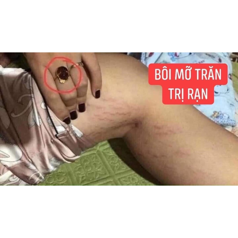 Combo Mỡ Trăn + Cám Gạo Cà Phê Dừa ( Tẩy da chết , mờ rạn da , mụn lưng ,…)