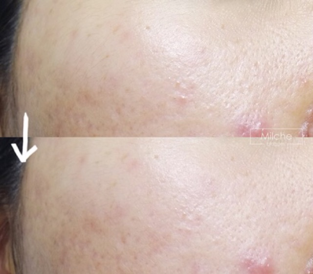 Tẩy da chết hoá học So Natural Red Peel Tingle Serum | BigBuy360 - bigbuy360.vn