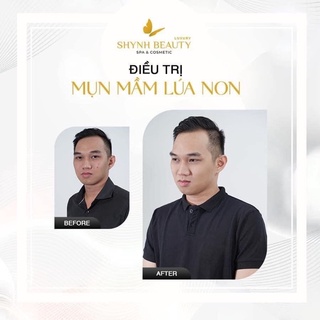 [ Hỏa Tốc ]MẦM LÚA NON MỤN 50ml❤️ - Shynh Beauty