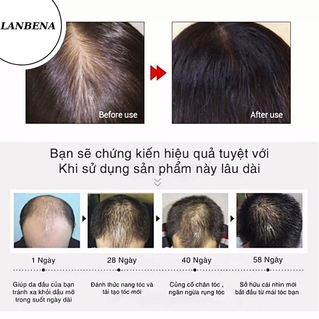 [CHÍNH HÃNG] Tinh Chất Kích Thích Mọc Tóc, Dưỡng Tóc Chuyên Sâu, Ngăn Ngừa Gãy Rụng, Đẩy Nhanh Quá Trình Mọc Tóc