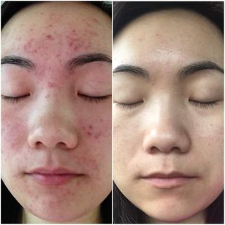 Serum chống lão hoá