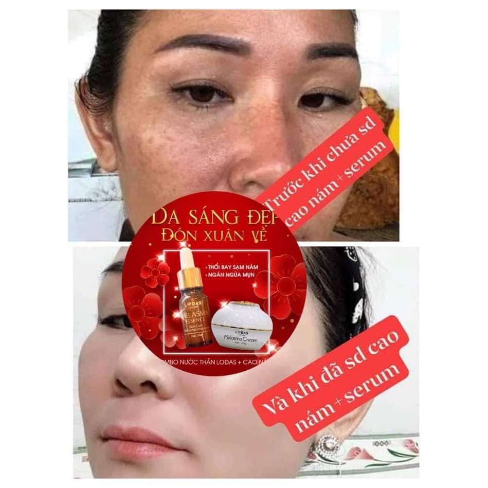 Cao Nám Lodas Cream Đan Thy- loại bỏ vết sạm nám giúp da bạn trở nên trắng hồng rạng rỡ tự nhiên