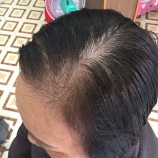 Tóc giả mái dài che hói