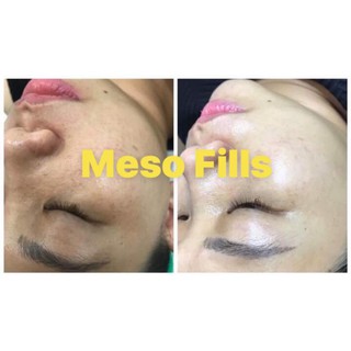 Serum tế bào gốc sợi Collagen nguyên bào trẻ hoá căng bóng da Meso Fills Hàn Quốc