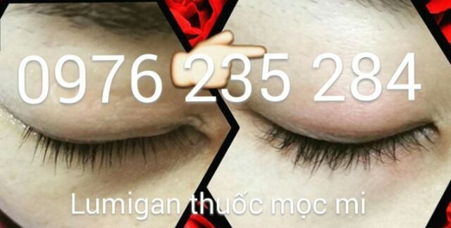 Lumigan Thuốc mọc dài mi của Mỹ | BigBuy360 - bigbuy360.vn
