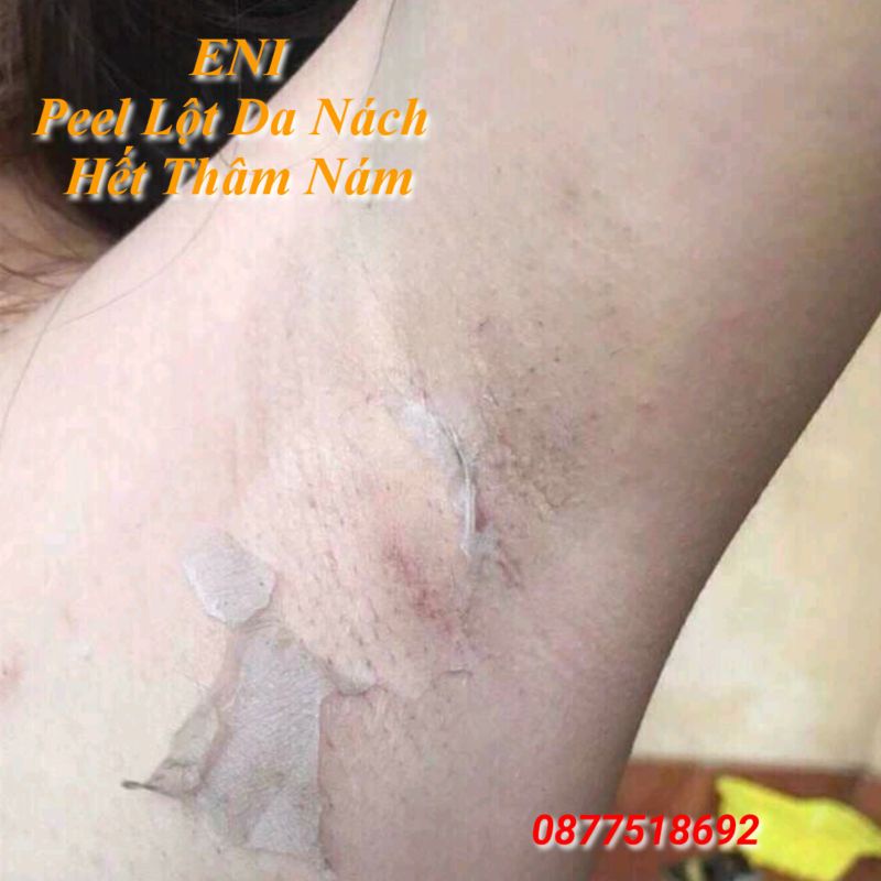 Peel Lột Nách Hết Thâm Sạm Trắng Da