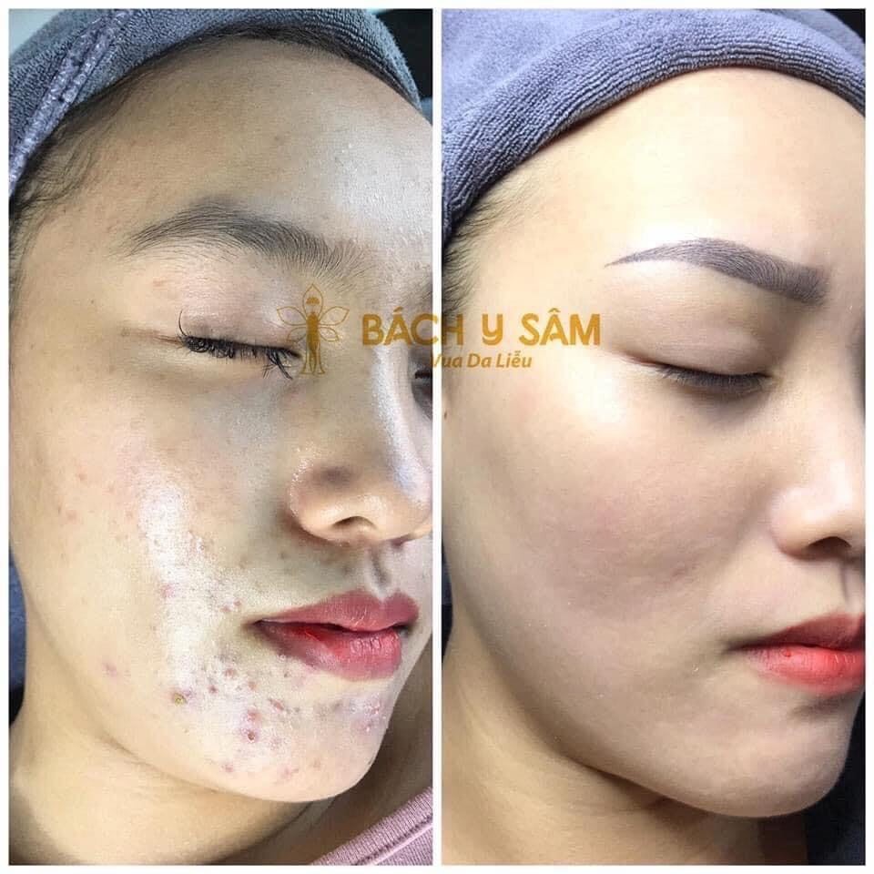 Bách Y Sâm 02 Plus 30ml Duyên Thị Bạch Linh Chuyên Mụn