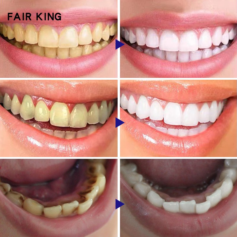 Tinh chất làm trắng răng FAIR KING chiết xuất cây trà loại bỏ vết bẩn mảng bám