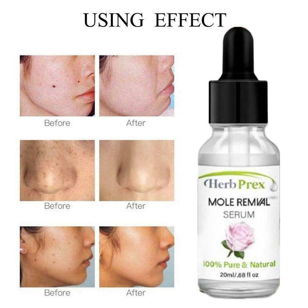 (Hàng Mới Về) Tinh Dầu Hữu Cơ 20ml Loại Bỏ Nốt Ruồi Hiệu Quả P6Q0 | BigBuy360 - bigbuy360.vn