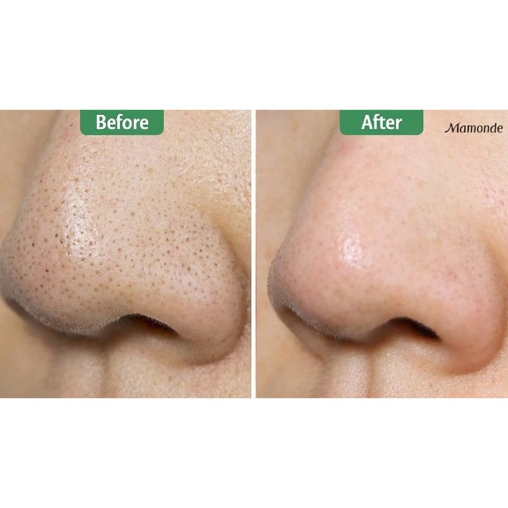 [COMBO Giảm Mụn][Mamonde] Thanh Lăn Mụn + Toner làm giảm mụn đầu đen, thu nhỏ lỗ chân lông, kiềm dầu - Lăn mụn mamonde | BigBuy360 - bigbuy360.vn