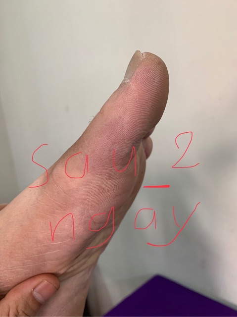 Gel bôi tan nhanh bầm tím - giảm sưng nề do chấn thương-sau thẩm mỹ DERMA BRUISING