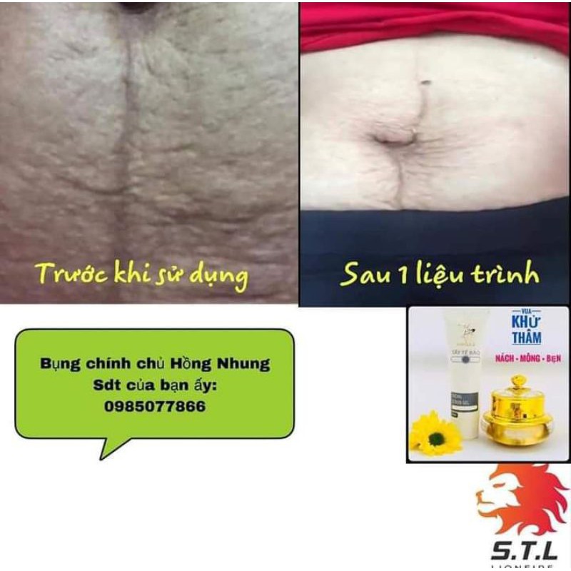 [CHÍNH HÃNG] SIÊU DƯỠNG THÂM 5S BIHO LADI | BigBuy360 - bigbuy360.vn