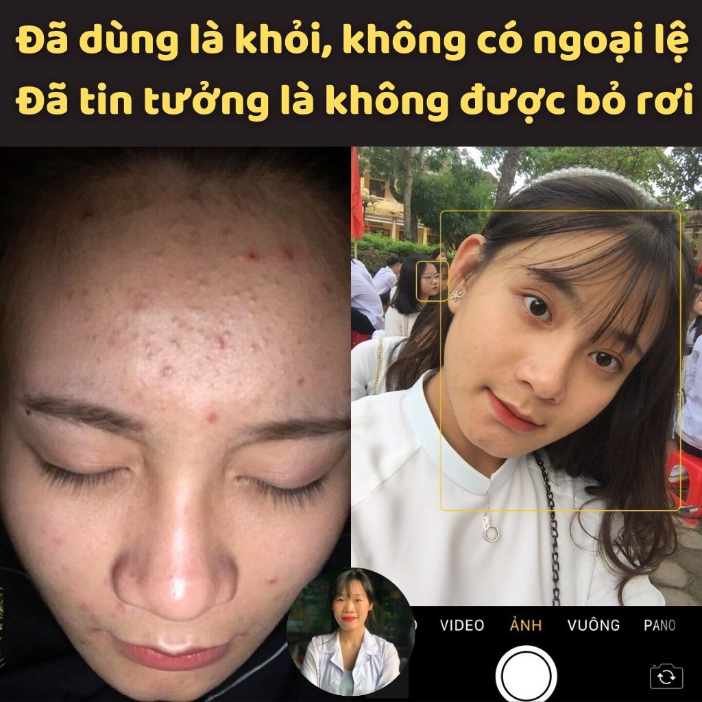 Serum ngừa mụn Lá Nam Acnes an toàn, tiết kiệm, không gây bong da, không xót rát, không sưng đỏ, đồng hành đến khi khỏi | BigBuy360 - bigbuy360.vn