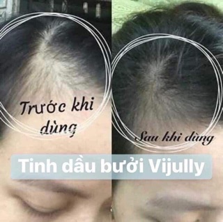 XỊT BƯỞI KÍCH MỌC TÓC VIJULLY