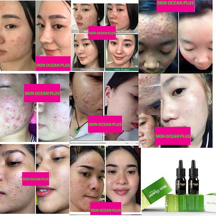 MỤN HẾT 100%, KHÔNG CÒN MỤN TRÊN DA, SERUM MỤN SKIN OCEAN PLUS ĐÁNH BAY HOÀN TOÀN CÁC LOẠI MỤN | BigBuy360 - bigbuy360.vn