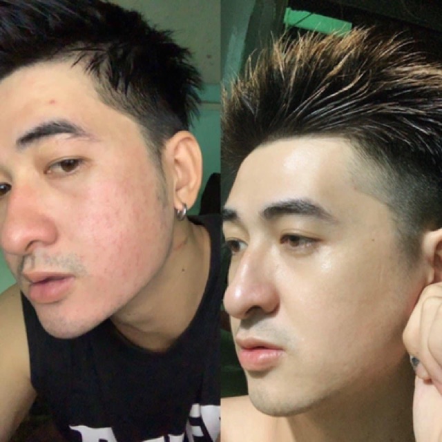 Trị Mụn Cao Cấp Sắc Mộc Thiên - Trị Mụn - Thâm - Sẹo Rỗ Tận Gốc | BigBuy360 - bigbuy360.vn