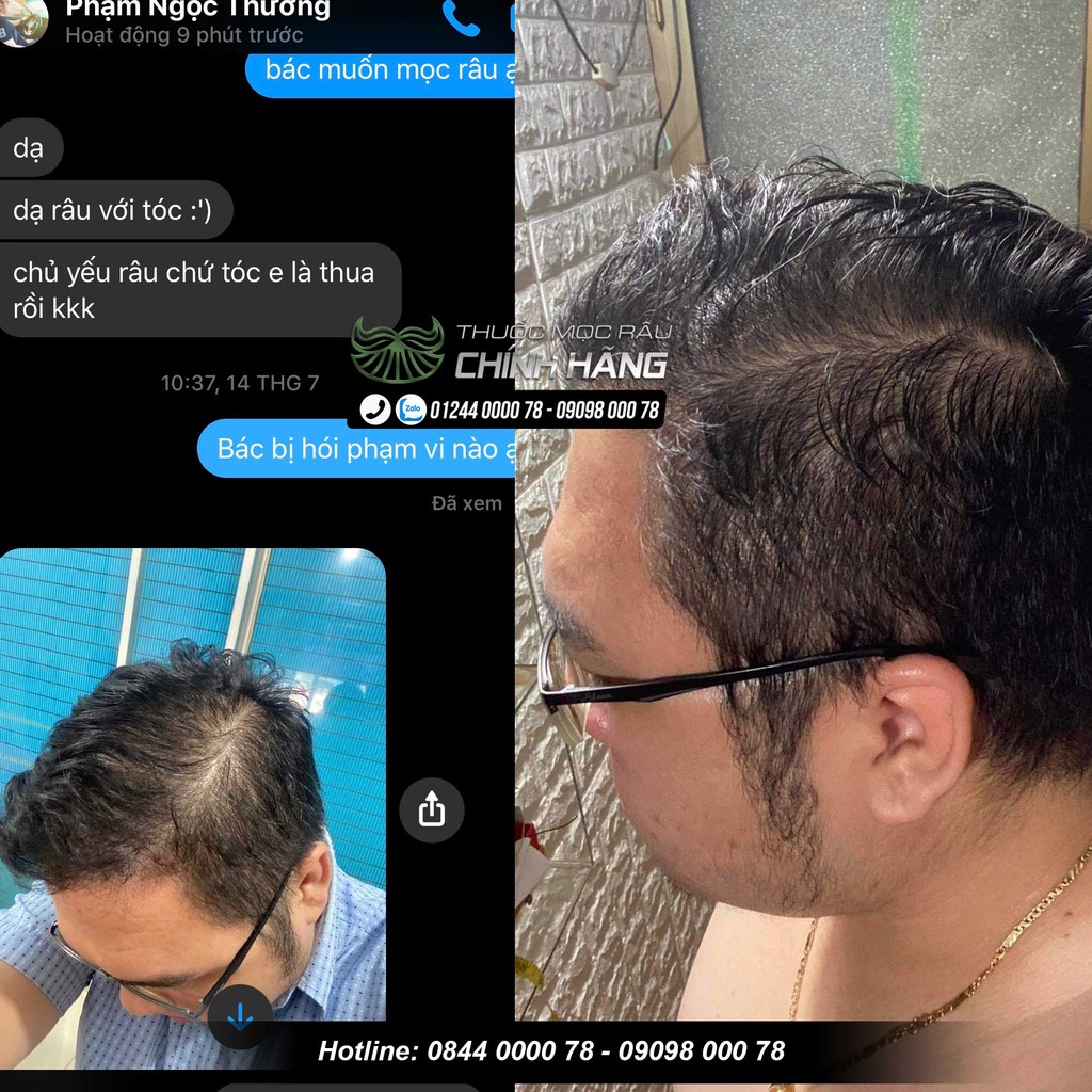 Dung dịch mọc tóc Morr F10 Minoxidil 10% và Finasteride