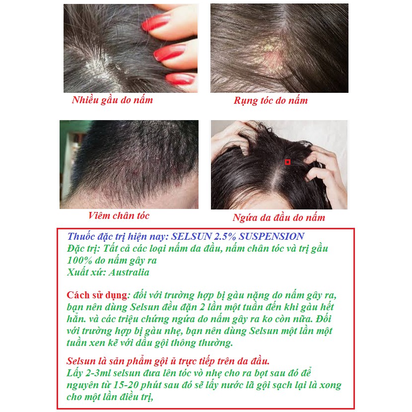 Trị gầu, nấm da đầu, rụng tóc do nấm gây ra đạt hiệu quả cao, an toàn khi sử dụng xuất xứ australia