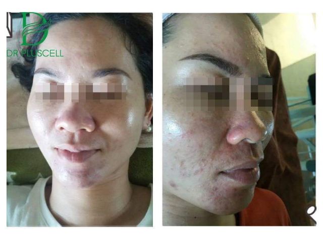 Siêu vi kim tảo biển Nano Tox Peel Dr Pluscell thế hệ đột phá mới 2019 | BigBuy360 - bigbuy360.vn