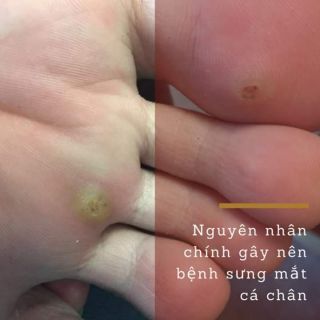Miếng dán mụn cóc,  dánh cơm