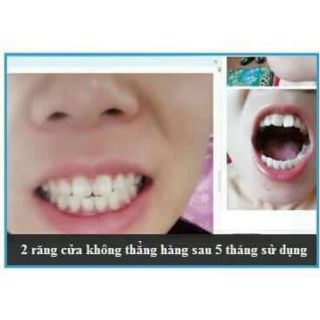 (A1+A2) Dụng cụ niềng răng cho trẻ em