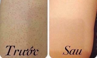 Lotion KELA trị viêm lỗ chân lông