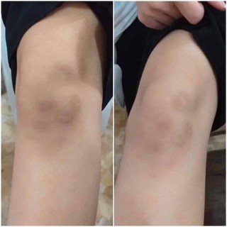 Trị thâm JIUHE cực đỉnh