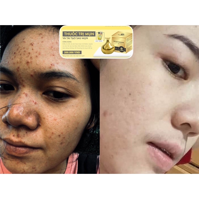 Kem Giảm Mụn Bamboo, Serum B5 Bamboo - Combo giảm mụn, phục hồi da hiệu quả