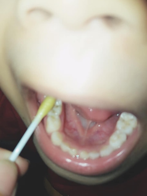 Nước súc miệng trị sâu răng xiết răng hôi miệng cho bé