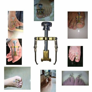 Dụng cụ chữa móng quặp