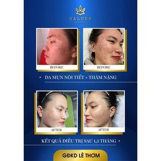 serum  mụn halora