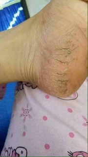 KEM CHUỐI TRỊ  NỨT GÓT  CHÂN  CỦA  THÁI