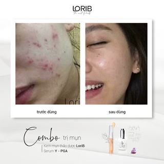 Combo sạch sâu đánh bay mụn Lori B ( Kem mụn thảo dược Lori B và Sữa rửa mặt than tre)