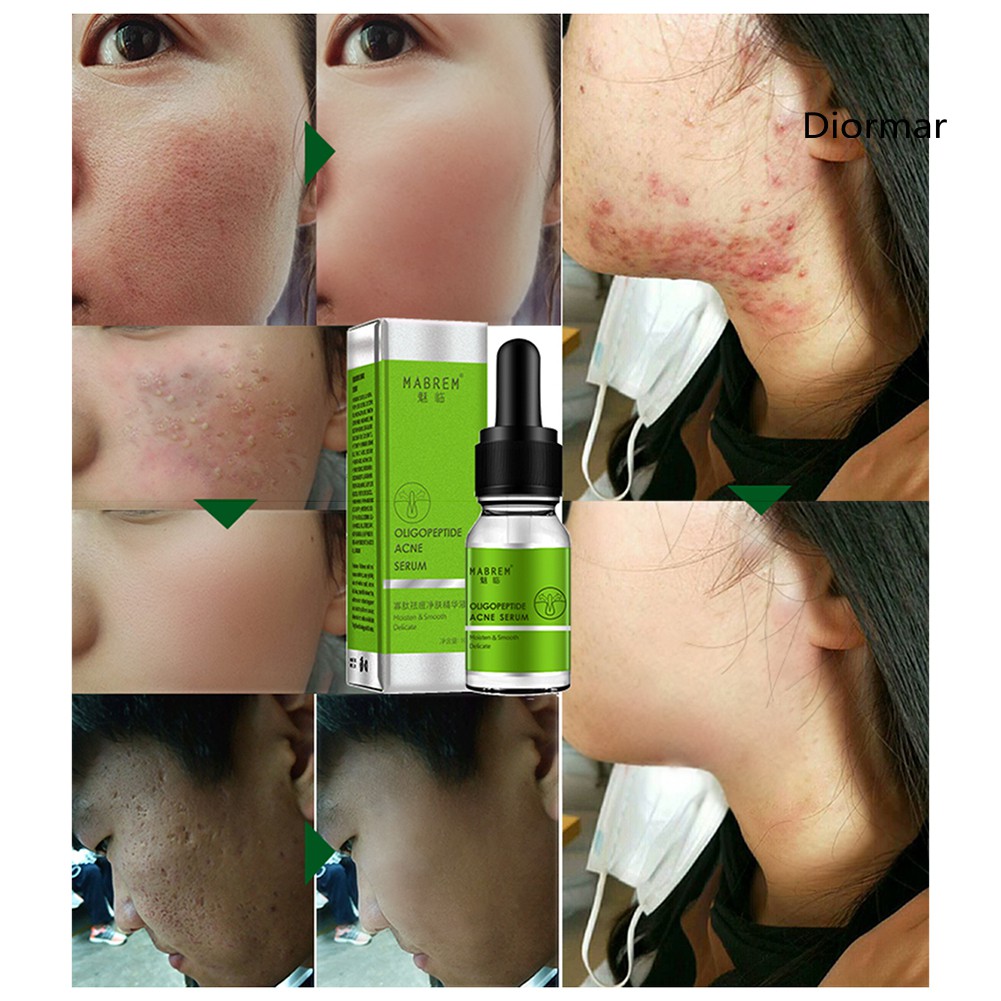 (Hàng Mới Về) Serum Trị Mụn Dưỡng Ẩm Kiểm Soát Dầu Dio Oliopeptide