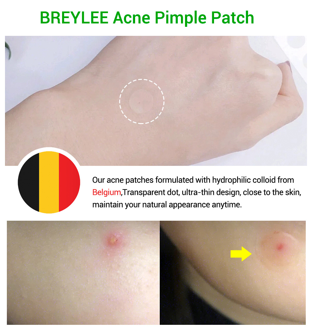 BREYLEECây Tràm Trà Trị Mụn Pox Sử Dụng Hàng Ngày+Đêm Mụn Pox Phai  0.1mm Trị Mụn Pox