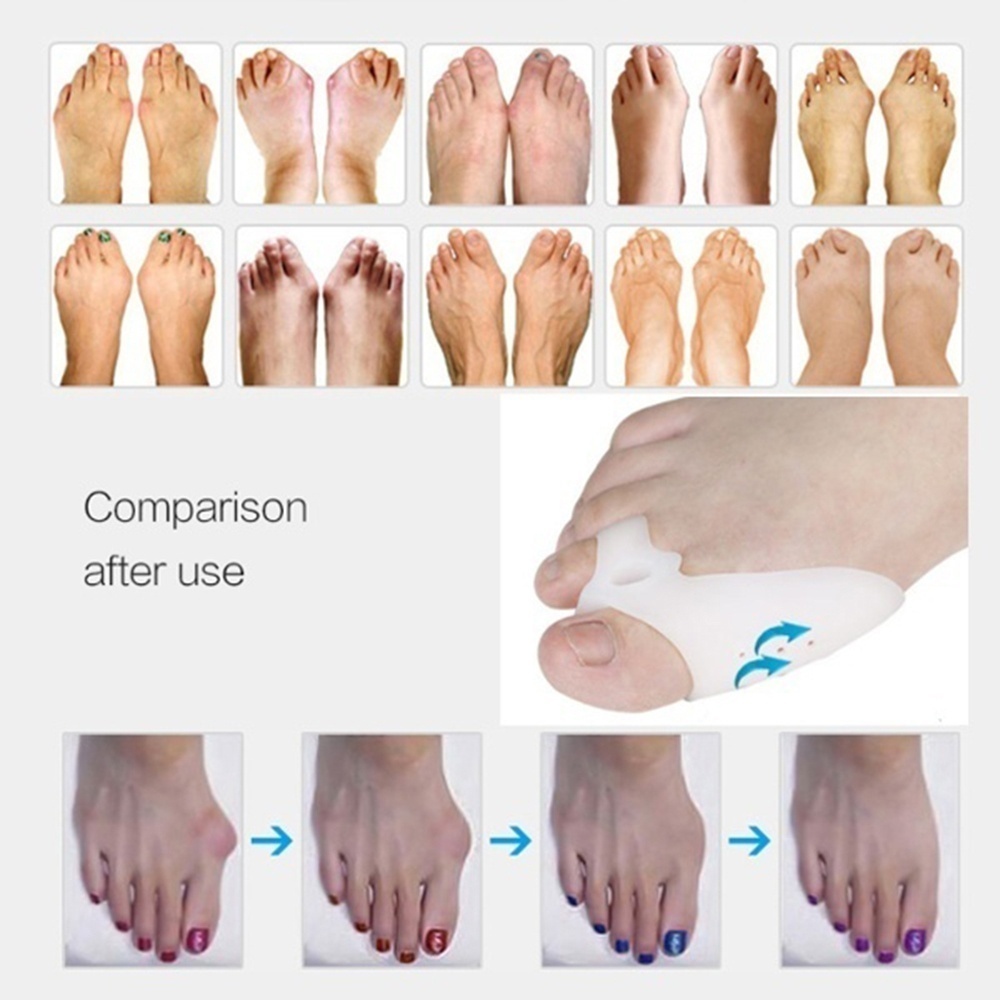 Dụng cụ tách ngón chân giảm đau có thể tái sử dụng