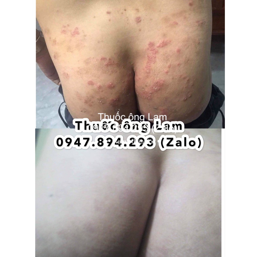 Hắc lào, nấm bẹn dứt điểm Đông Y gia truyền Ông Lam | BigBuy360 - bigbuy360.vn