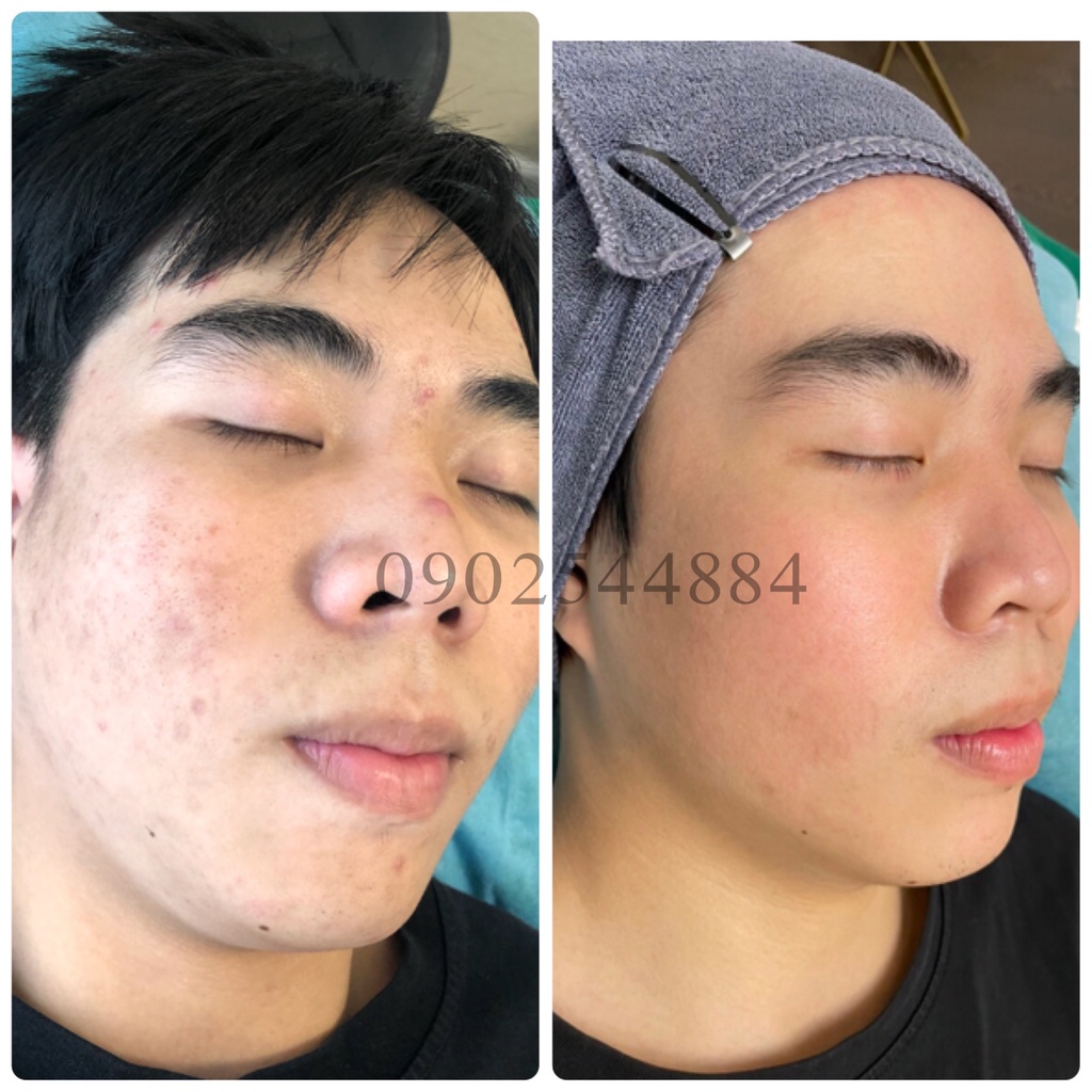 Serum mụn Hoàng Trinh
