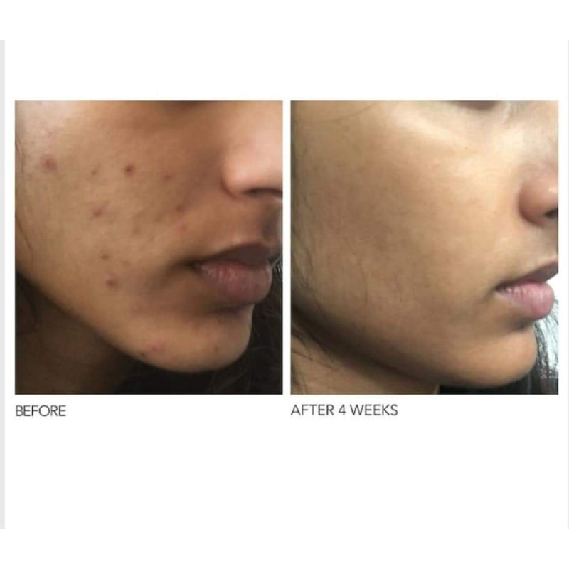 [ xả lỗ date 2026]  Dr Dennis Gross alpha beta peel tẩy da chết sét 2 gói | BigBuy360 - bigbuy360.vn