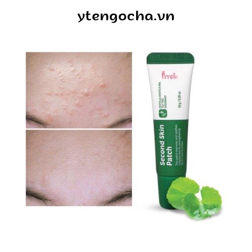 Gel bảo vệ da mụn rau má Prreti loại bỏ bã nhờn chăm sóc da dịu nhẹ tự nhiên 10g, Gel Dán Mụn Second Skin Patch 10g