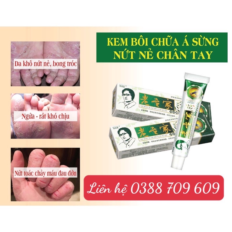 Kem Bôi Ngoài Da Chống Nứt Nẻ Bong Tróc Khô Da,hắc lào,vảy nến,nấm chân tay...