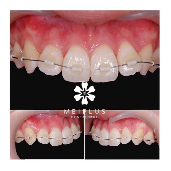 Hỗ trợ chỉnh nha tiền phục hình Jiscop _Hàn Quốc