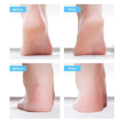 Tẩy Tế Bào Chết và Dưỡng Da Dạng Xịt Cho Bàn Chân Mềm Mại và Mượt Mà Bookki Baby Foot Peeling Spray Gomi Mall