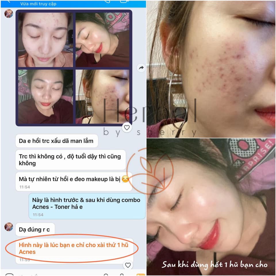 HERBAL ACNES MEDIPRO CREAM - Kem mụn thảo dược (15ml) | BigBuy360 - bigbuy360.vn