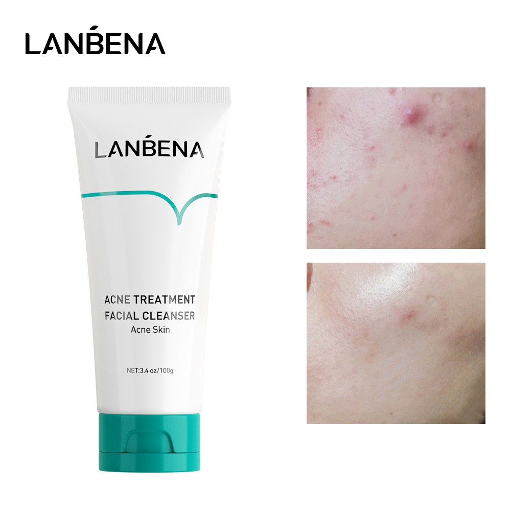 Set 4 Mỹ Phẩm Giảm Mụn LANBENA Gồm Miếng Dán+Gel+Sữa Rửa Mặt Kiềm Dầu Làm Mịn Loại Bỏ Mẩn Đỏ Phục Hồi Chăm Sóc Da