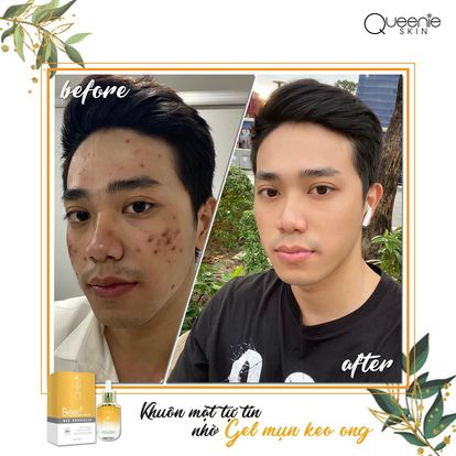 [FreeShip + Tặng Quà] Gel Mụn Keo Ong Queenie Skin Date Mới Nhất - Gel Mụn Queenie Skin Date 2023