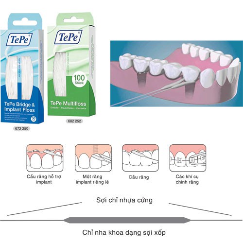 Chỉ Nha Khoa Cho Cầu Mão Răng Và Implant Tepe Bridge &amp; Implant 5 Cái