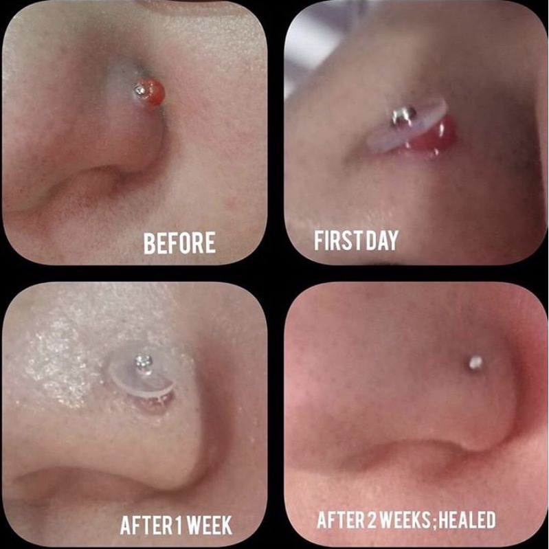 Miếng nẹp giảm bump, chống sưng